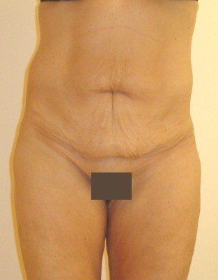 Tummy Tuck Before And After Photo