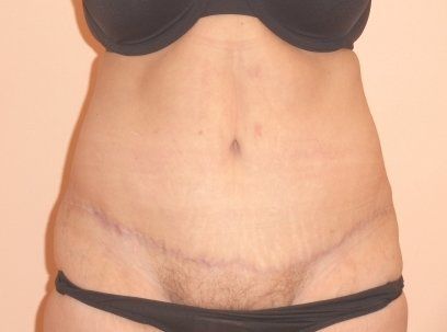 Tummy Tuck Before And After Patient 28