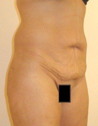 Tummy Tuck Before And After Photo