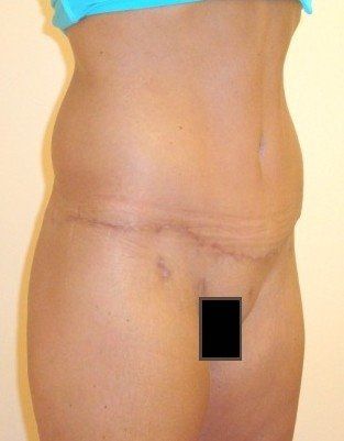 Tummy Tuck Before And After Photo