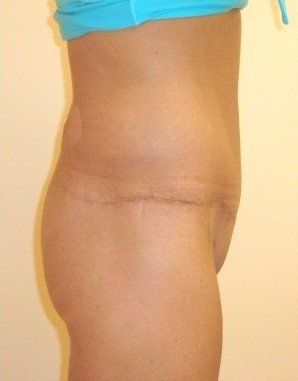 Tummy Tuck Before And After Photo