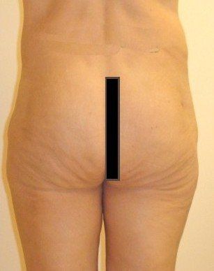 Tummy Tuck Before & After Image