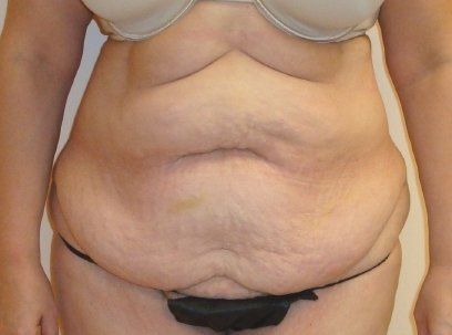 Tummy Tuck Before And After Photo