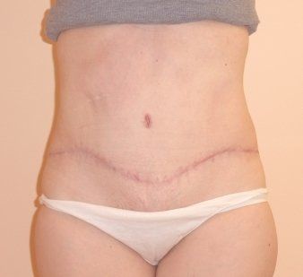 Tummy Tuck Before And After Patient 29