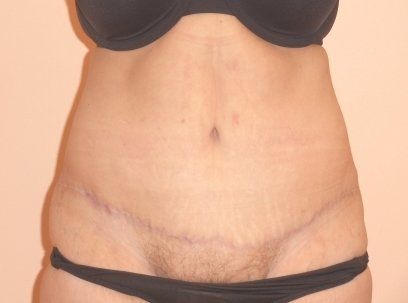 Tummy Tuck Before And After Photo