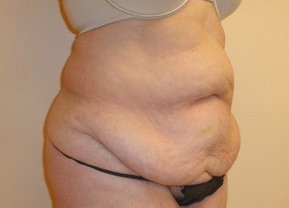 Tummy Tuck Before And After Photo