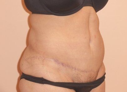 Tummy Tuck Before And After Photo