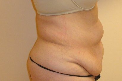 Tummy Tuck Before And After Photo