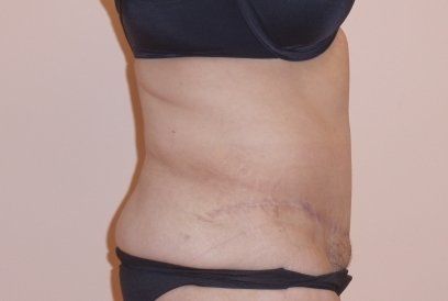 Tummy Tuck Before And After Photo