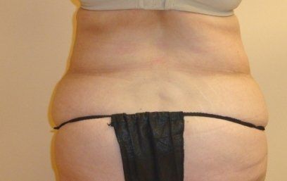 Tummy Tuck Before And After Photo