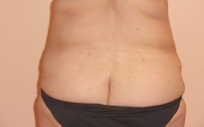 Tummy Tuck Before And After Photo