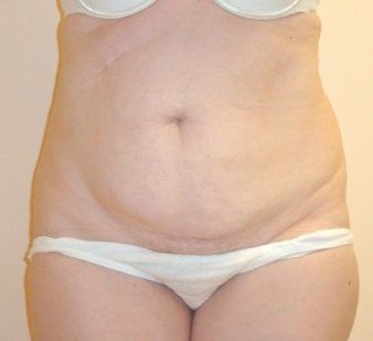 Tummy Tuck Before And After Photo