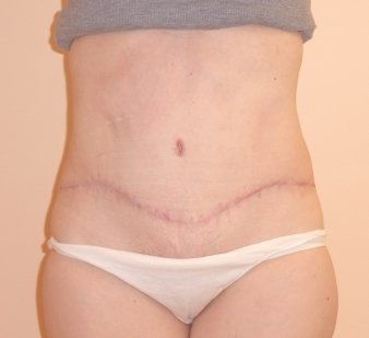 Tummy Tuck Before And After Photo