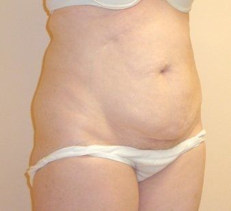 Tummy Tuck Before And After Photo