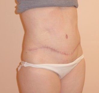 Tummy Tuck Before And After Photo