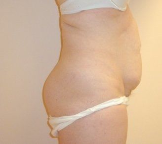 Tummy Tuck Before And After Photo