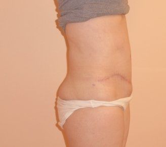 Tummy Tuck Before And After Photo