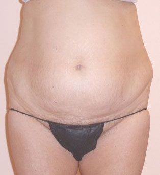 Tummy Tuck Before And After Photo