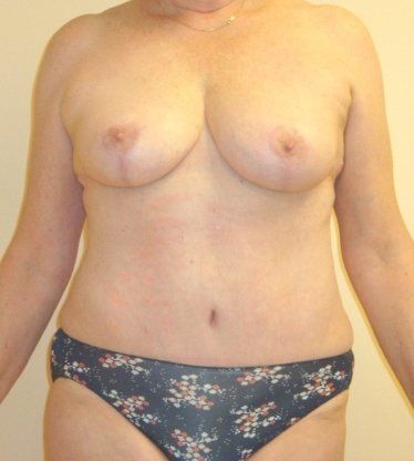 Abdominoplasty & Liposuction of Posterior Hips Before And After Patient 31