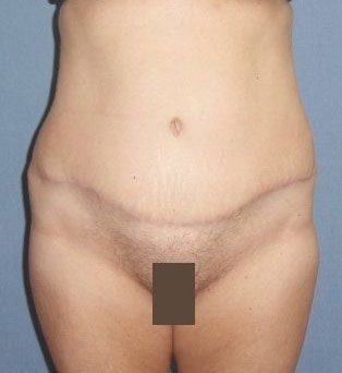 Abdominoplasty & Liposuction of Posterior Hips Before And After Patient 31