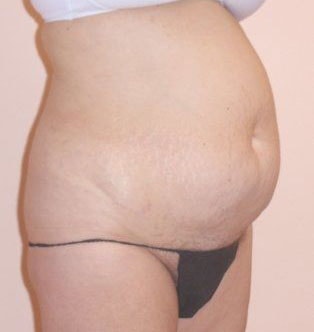 Tummy Tuck Before And After Photo