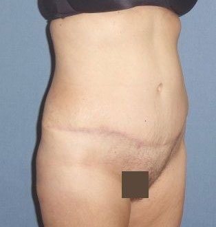 Tummy Tuck Before & After Image