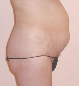 Tummy Tuck Before And After Photo