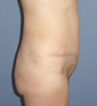 Tummy Tuck Before And After Photo