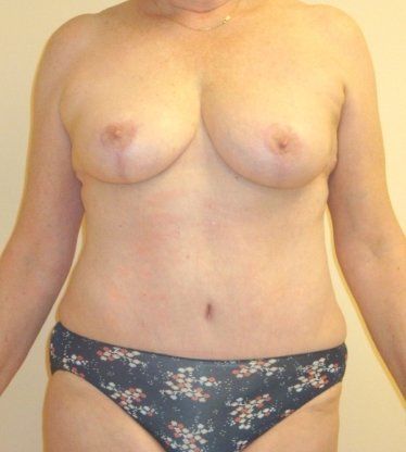 Abdominoplasty & Liposuction of Posterior Hips Before And After Patient 32