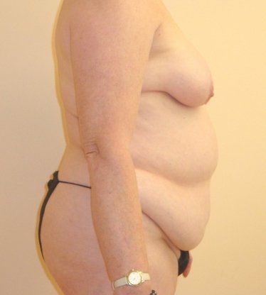 Tummy Tuck Before And After Photo