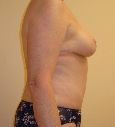 Tummy Tuck Before And After Photo