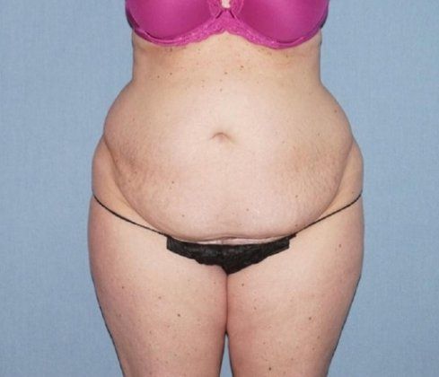 Tummy Tuck Before And After Photo