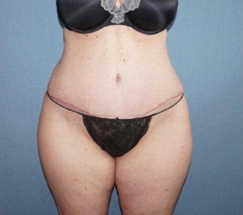 Tummy Tuck Before And After Photo