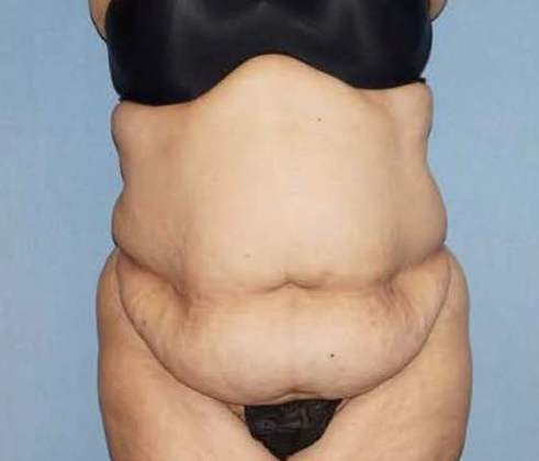 Tummy Tuck Before And After Photo