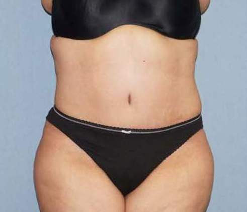 Tummy Tuck Before And After Photo