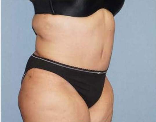 Tummy Tuck Before And After Photo