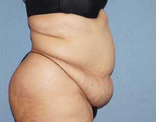 Tummy Tuck Before And After Photo