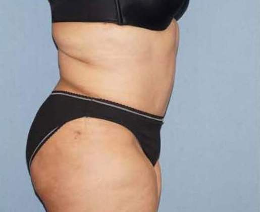 Tummy Tuck Before And After Photo