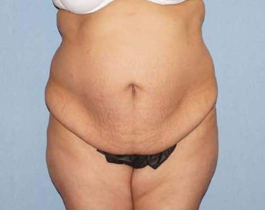 Tummy Tuck Before And After Photo