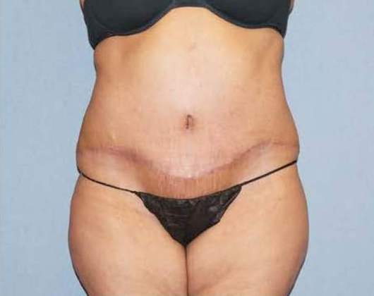 Tummy Tuck Before And After Photo