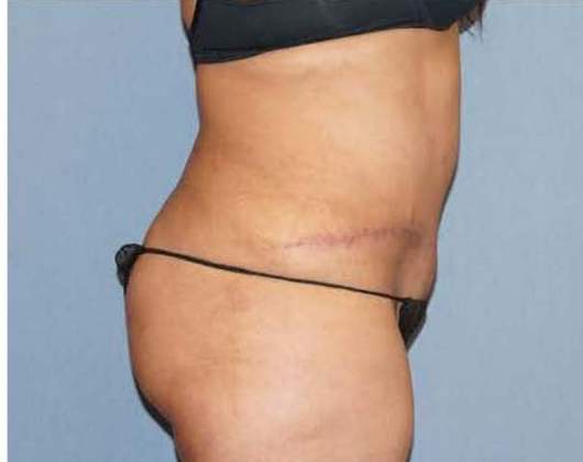 Tummy Tuck Before And After Photo