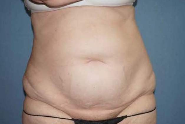 Tummy Tuck Before And After Photo