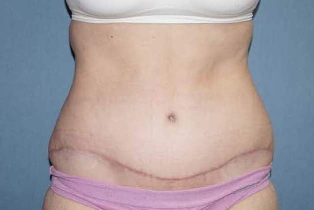 Tummy Tuck Before And After Photo