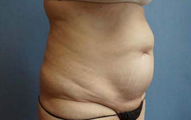 Tummy Tuck Before And After Photo