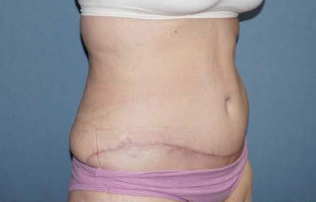 Tummy Tuck Before And After Photo