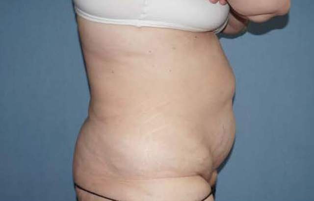 Tummy Tuck Before And After Photo