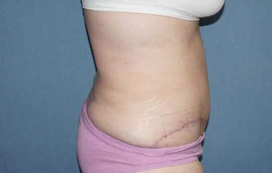 Tummy Tuck Before And After Photo