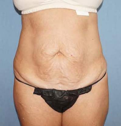 Tummy Tuck Before And After Photo