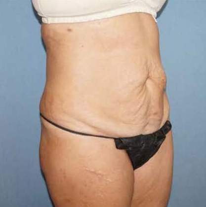 Tummy Tuck Before And After Photo