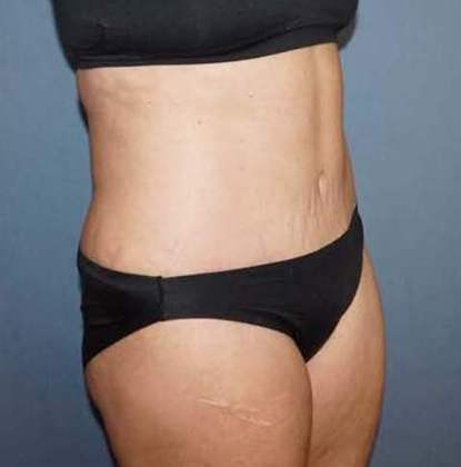 Tummy Tuck Before And After Photo